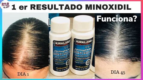 Minoxidil Antes Y Despu S En Dias Funciona Recuperandomisrizos