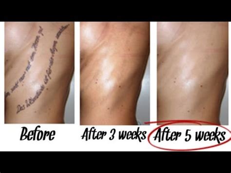 Best Way To Remove Tattoos Naturally Within 5 Weeks YouTube