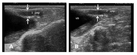 Ultrasound Image Of Pampiniform Plexus A Right Pampiniform Plexus