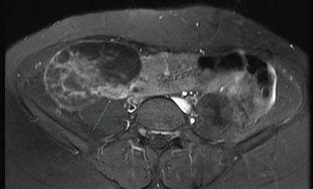 Ovarian Torsion Radiology Case Radiopaedia Org