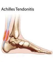 Tendon Achilles Tendonitis Causes Symptoms Diagnosis Treatments