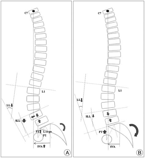 Illustration Showing The Difference Of Sagittal Spinopelvic Alignment