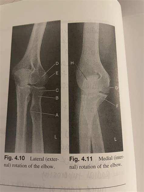 Lateral Medial Elbow Diagram Quizlet