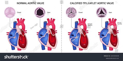 12 Calcified Aortic Valve Images, Stock Photos & Vectors | Shutterstock