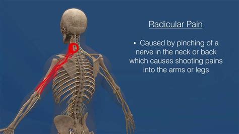 Lumbar Radicular Pattern