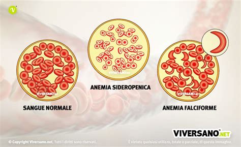 Anemia Microcitica Falciforme E Altri Tipi Cause Sintomi E Rimedi