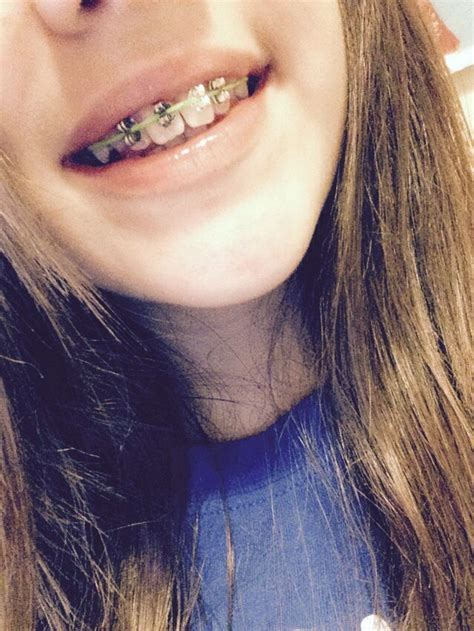 Fake Braces Rainbow Loom Rubber Bands Braces Rubber Bands