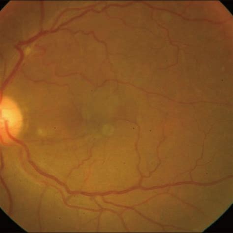 Left Eye After Vitrectomy With Epiretinal Membrane Removal Shows Clear Download Scientific