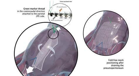 Dynamesh Ipom Surgical Mesh Implants Hernias Kebomed