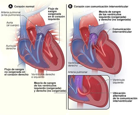 Cardiopatías congénitas Tipos NHLBI NIH