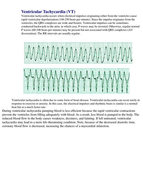 Ppt Ventricular Tachycardia Vt Powerpoint Presentation Free