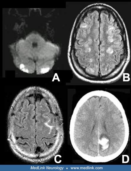 Reversible Cerebral Vasoconstriction Syndromes Medlink Neurology