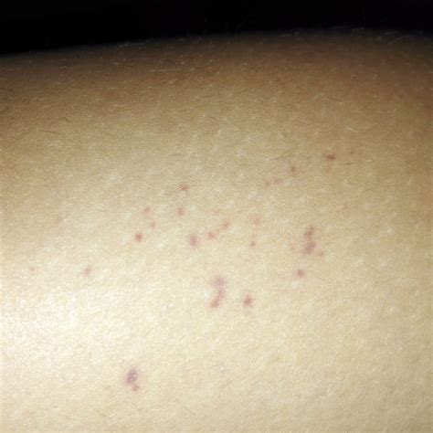 Puntitos Rojos Morados En La Pierna Dermatologo Net