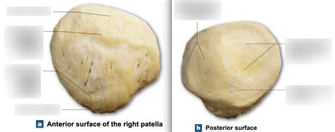 Patella Anatomy (Sesamoid bone) (Chapter 7 Appendicular) Diagram | Quizlet