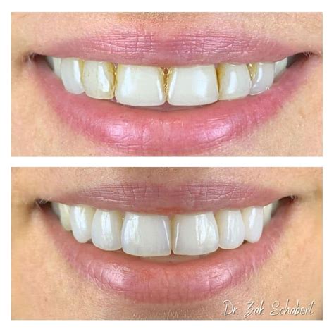 Dental Before And After Dental Results Cde