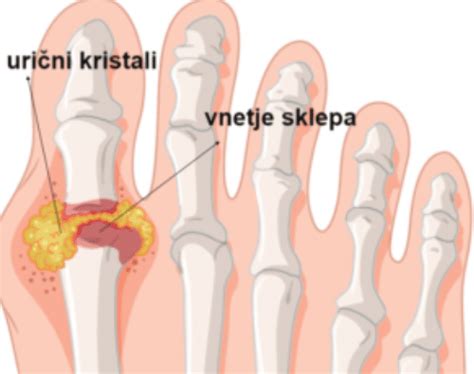 Vnetje Sklepov Kako Si Pomagati Vzroki Znaki In Zdravljenje