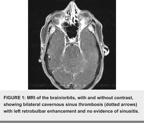 Figure 1 From Septic Bilateral Cavernous Sinus Thrombosis With Persistent Methicillin Resistant