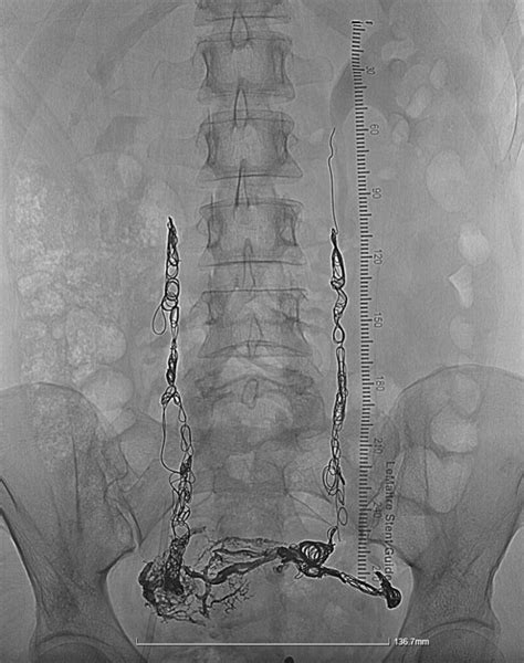 Pelvic Congestion Syndrome Stavros Kalliafas Md Vascular