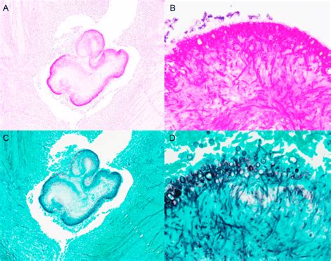 A) PAS stain highlights the mats of fungal hyphae. B) Higher... | Download Scientific Diagram