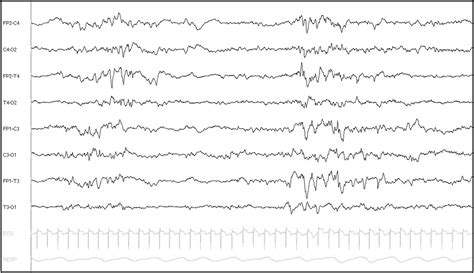 Neonatal Scn A Encephalopathy A Peculiar Recognizable Electroclinical