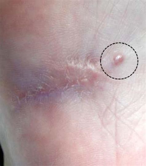 SciELO Brasil Amelanotic Metastatic Cutaneous Melanoma Amelanotic