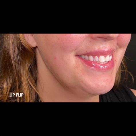 Lip Flip Skin Lab Med Spa