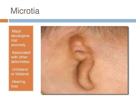 Diseases of external ear