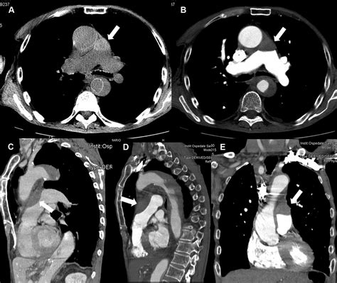 Pulmonary Artery Intramural Hematoma Associated With Stanford Type B