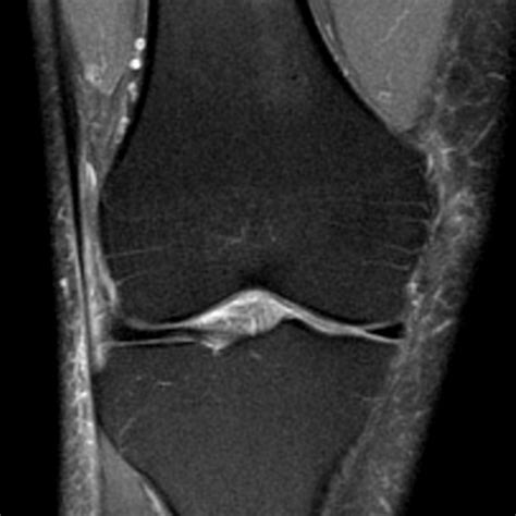 Radiologia Do Esporte S Ndrome Do Trato Lio Tibial