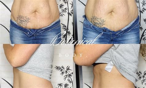 Gluteoplasty Butt Lift Non S Botanical Body Groupon