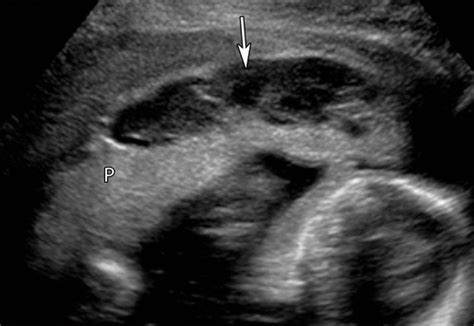 Placental Imaging Normal Appearance With Review Of Pathologic Findings