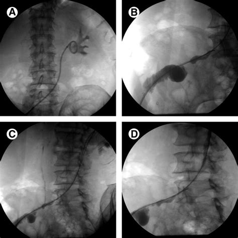 Percutaneous Ureteral Interventions Techniques In Vascular