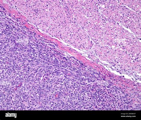 Tumor Maligno De La Vaina Del Nervio Perif Rico Micrograf A De Luz El