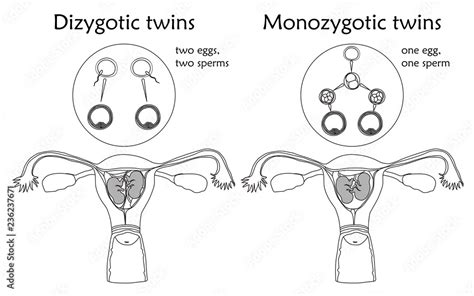 Multiple Pregnancy Dizygotic And Monozygotic Twins Embryo Fetus In