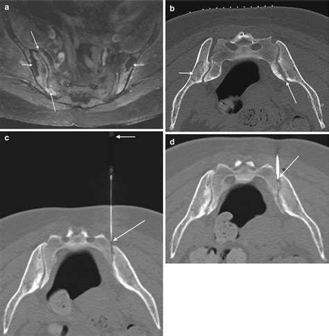 Sacral Biopsy Radiology Key