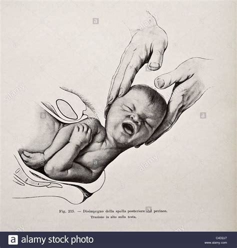 Download This Stock Image Illustration Of Human Birth Copyright 1905