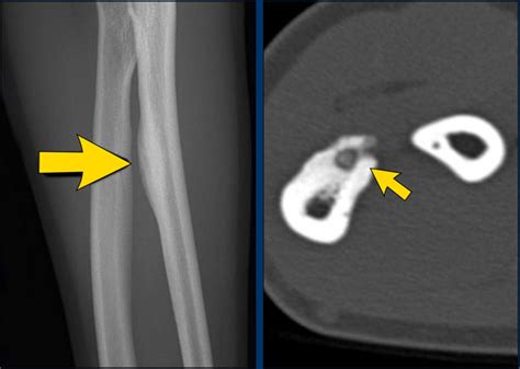 The Radiology Assistant Bone Tumors Differential Diagnosis