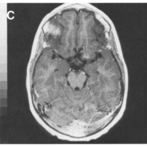 Gadolinium Enhanced Tl Weighted Axial Magnetic Resonance Imaging Scans