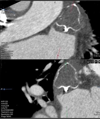 Abstract 14098 Early Recurrence Following Resolution Of A Watchman