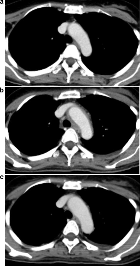 A Initial Contrast Enhanced Computed Tomography Ce Ct Showing No