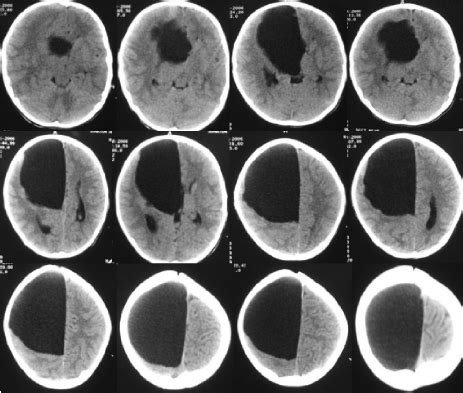 CT scan shows a large arachnoid cyst extending from... - Figure 1 of 3