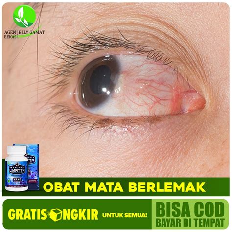 Jual Obat Mata Berlemak Lemak Pada Mata Pterygium Paling Aman Limatta