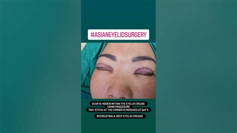 Double Eyelid Surgery Blepharoplasty Upper Eyelid Surgery Asian