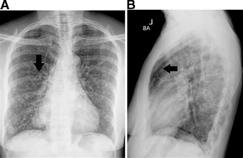 Pa And Lateral Chest X Ray Frontal And Lateral Views There Are