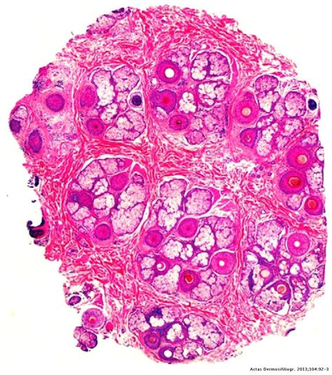 Dermoscopy Of Early Dissecting Cellulitis Of The Scalp Simulates Alopecia Areata Actas Dermo