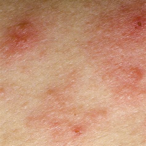 Diseases that Cause Eczema | Livestrong.com