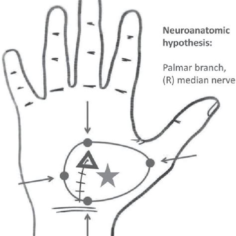 Sample Allodynia Map A Neuroanatomic Hypothesis Designates The