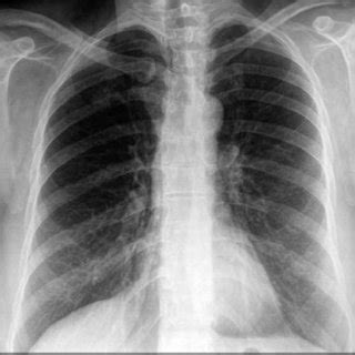 The Postero Anterior Chest X Ray Of The Patient Showing A Round Nodule