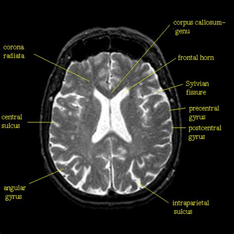 SHUNT SELECTION MODEL: CNS Shunt Monitoring and In-Vivo Analysis with the DiaCeph Test, a Single ...