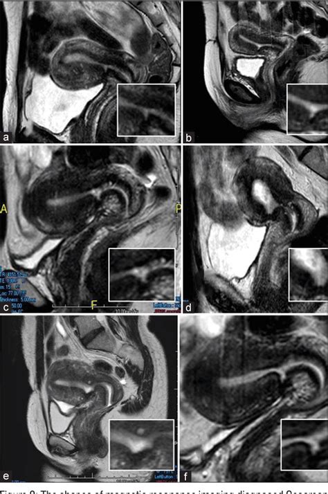 Magnetic Resonance Imaging In The Evaluation Of Cesarean Scar Defect